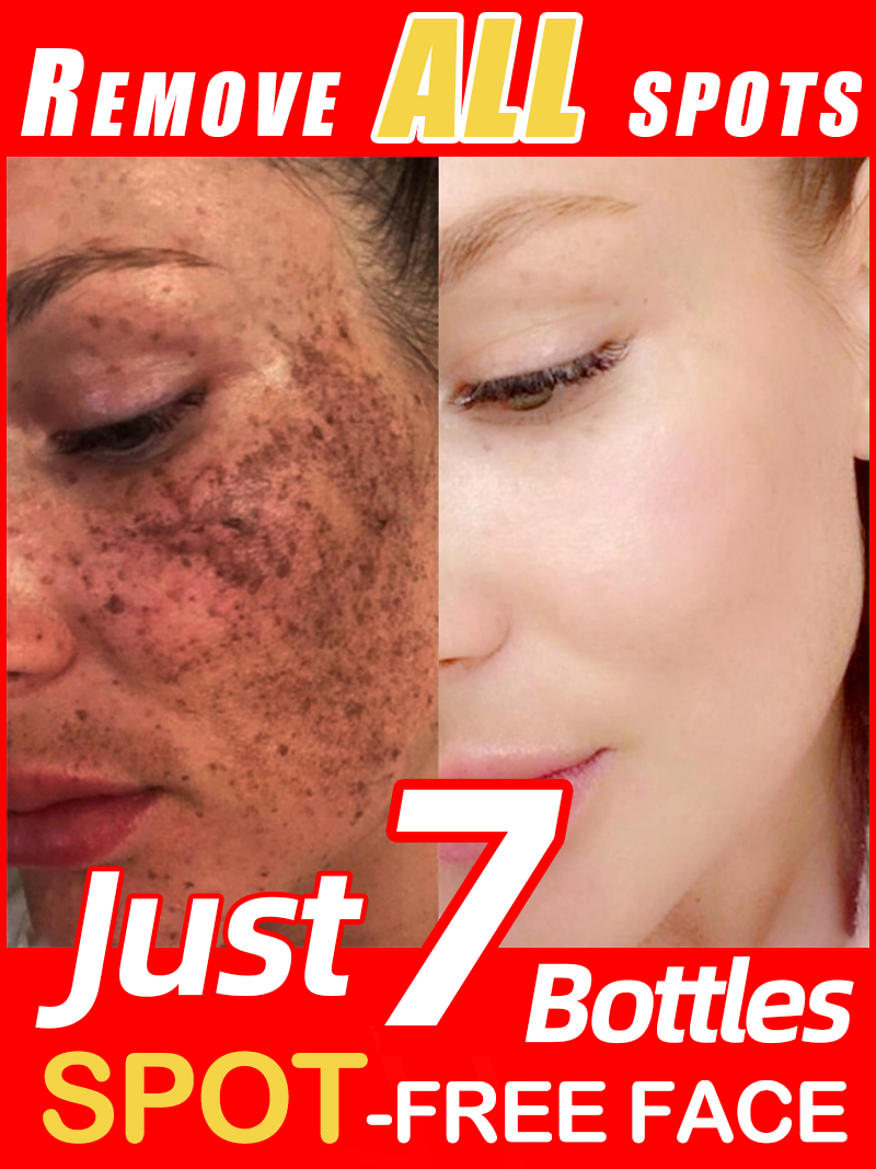 Skincare Luxury Whitening - Çilleri, Melazmayı ve Yüzdeki Koyu Lekeleri